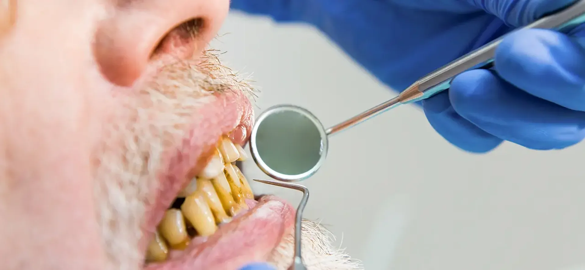 Doença periodontal é uma das principais causas de perda total de dentes; conheça outros tipos de infecções