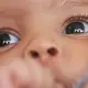 Diagnóstico precoce do retinoblastoma previne cegueira infantil